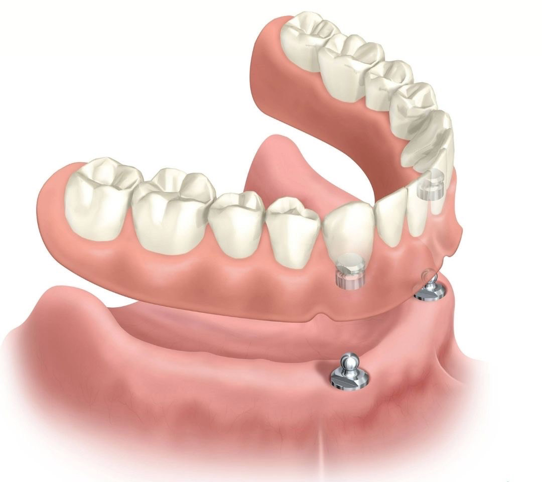 Stomatologia Słubice – sprawdź ofertę na profesjonalne protezy zębowe