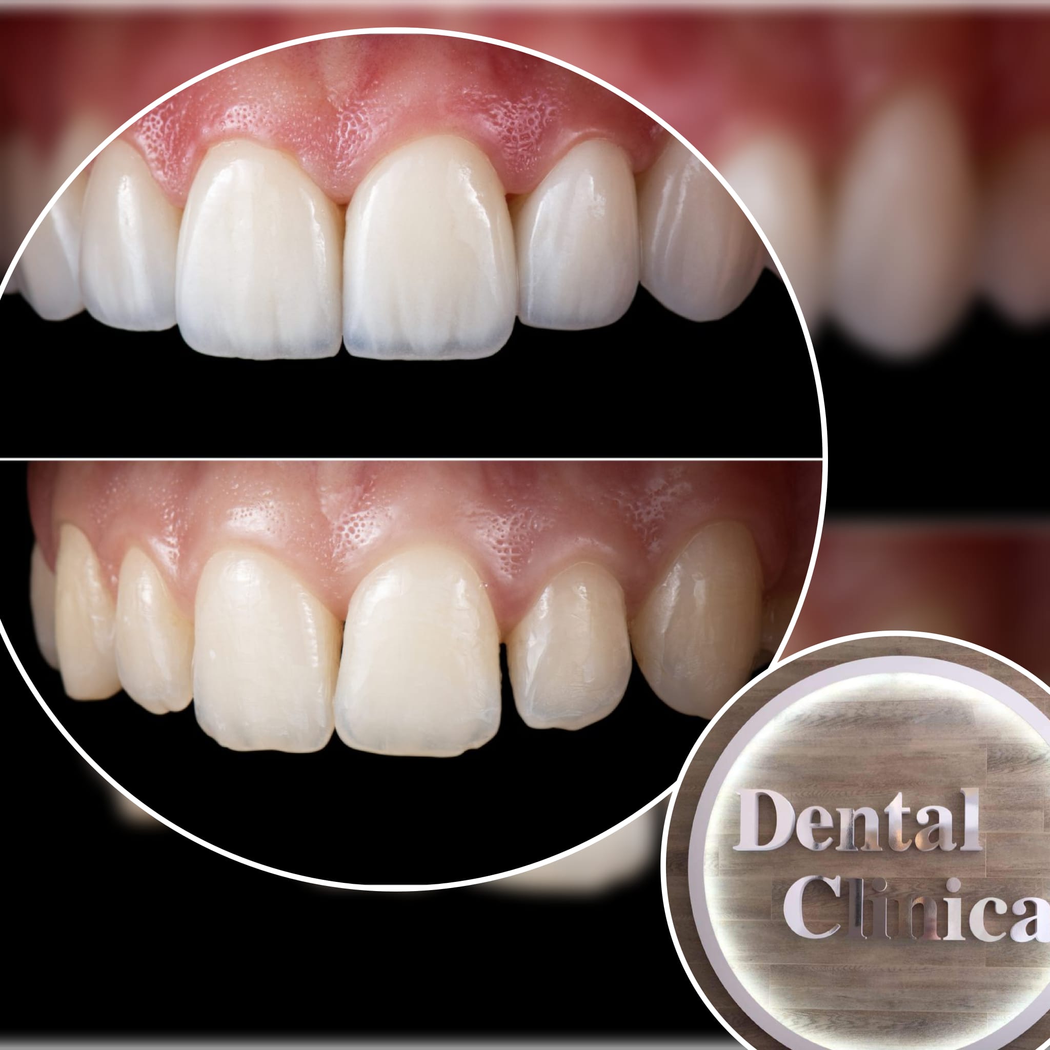 Bonding w Dental Clinica w Słubicach